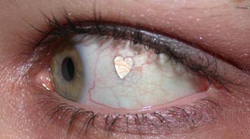 Implant réalisé dans l'oeil
