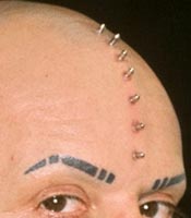 Implants Transdermiques (Lukas Zpira)